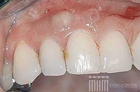 El Absceso Dental Es Una Pequena Bolsa De Pus Que Crece