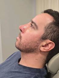 Presentamos un caso muy interesante. , Antecedente de cirugía previa. Fue  necesario tomar un poquito de cartílago de la costilla para poder darle  nueva forma a la nariz., Dimos soporte a la punta, ya ...