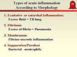 • inflammation exists until is eliminated the etiological factor and are inactivated inflammatory mediators. Pathophysiology L 4 Inflammation Prof Fakhir Alani Fakeralani