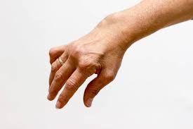 Fingerschmerzen Schmerzen In Den Fingern Ursachen Und Wirksame Behandlung Heilpraxis