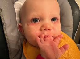 Asher is now three years old, but these pictures are from his first year of  life. His skin has good days and bad days. It appears darker red when he is  warm,