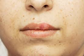 In many cases there are no symptoms and the infected person does not. Herpes In Females Symptoms Diagnosis And Treatment