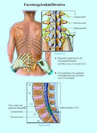 Bei einem facettensyndrom verschiebt sich die wirbelsäure. Facettensyndrom Lumbales Lumboischialgie Osteochondrose Sport