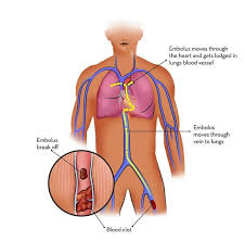 The difference here is that while coughing up blood clots may unfortunately be common place for sufferers of long term and chronic conditions like lung cancer and bronchitis, it can also be a symptom of a pulmonary embolism. Pulmonary Embolism Causes Symptoms Types Risk Factors And Treatment