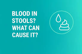 Image result for Blood in stool