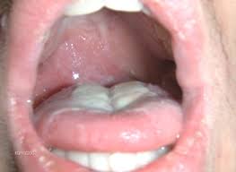 Image result for Peritonsillar Abscess
