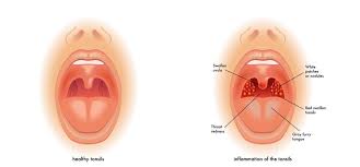 Patologia Y Tratamiento Garganta Amigdalitis