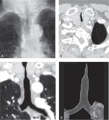 It usually heralds recovery and is the result of increased granulocyte a. 17 Tracheal Stenosis Radiology Key