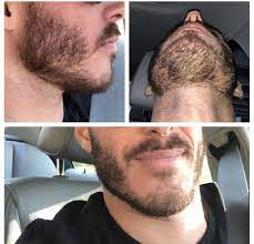 Your hair grows about 6 inches per year. Could I Grow A Solid Beard 3 5 Weeks In Semi Patchy Patchy Beard Patchy Beard Styles Beard