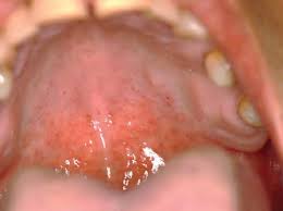 Image result for Oral thrush roof of mouth