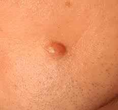 Image result for Spitz Nevus