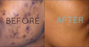 Ingredients 1 Teaspoon Of Olive Oil 1 Half Teaspoon Of Honey 1 Teaspoon Of Baking Soda Pre Post Inflammatory Hyperpigmentation Skin Treatments Beauty Hacks
