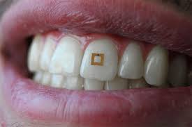 Tooth Mounted Sensors Track Your Diet And Health From Inside Your Mouth Tooth Implant Cost Teeth Implants Dental Implants Cost