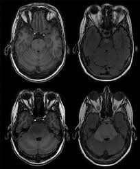 Image result for Incidental Imaging Finding
