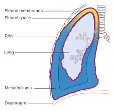 Multiple nuclei in some cells File Diagram Of The Lung Showing Pleural Mesothelioma Cruk 458 Svg Wikimedia Commons