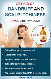 Try These Tips To Get Rid Of Dandruff And Itchy Scalp Fast Home Remedies For Dandruff And S Home Remedies For Dandruff Getting Rid Of Dandruff Dandruff Remedy