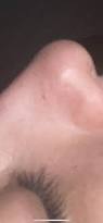 Image result for skin cancer on nose pimple