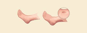 Image result for Angioedema