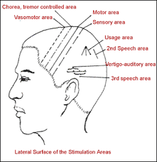 Scalp Therapy Yao S Acupuncture For Pain Depression Ptsd Parkinson S Disease