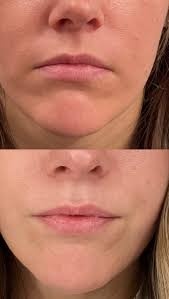 Cheeks are definitely one of my favorite areas of the face to treat. I  think most people can benefit from a little cheek support without knowing  it. Products: ✖️Voluma ✖️Restylane Contour ✖️Restylane