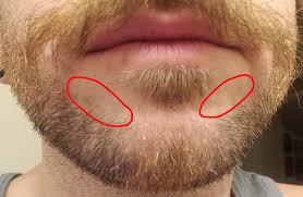 Men who can't grow a beard or have patchy beards usually have normal testosterone levels. A Real Life Facial Hair Transplant Dilemma Wonder Web Development