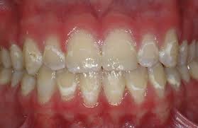 Where do the white spots on teeth come from? White Spot Lesions Prevention And Treatment American Journal Of Orthodontics And Dentofacial Orthopedics