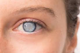 Once your eyes get used to the presence of the lenses, the excessive tears will go away. Why Do Contacts Sometimes Cause Cloudy Vision What To Do Nvision Eye Centers