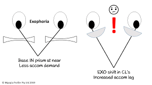 What About The Exophores Myopia Profile Binocular Vision Myopia Control