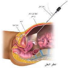 تنظير البطن ويكيبيديا