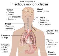 Glandular Fever Mydr Com Au