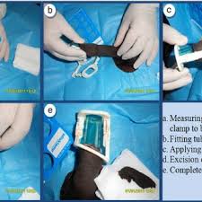 1 doctor answer • 4 doctors weighed in 90,000 u.s. Appearance After Circumcision A Penis After Clamp Removal On Day 5 Download Scientific Diagram