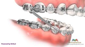 Treatment of an overbite using braces can take anywhere from six months to two years. Orthodontic Treatment For Overjet Overbite Forsus Appliance Youtube
