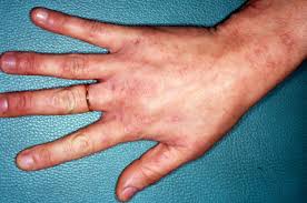 Image result for scabies human bites
