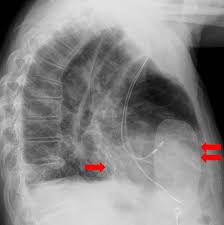 Diş hekimi röntgen çekilirken neden odadan dışarı çıkar? Kardiologie Herzschrittmacher Defibrillatoren Kardiale Resynchronisations Therapie