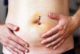 A person can see the tissue protruding outward from the navel. How Long Does It Take To Recover From An Umbilical Hernia Repair Surgery
