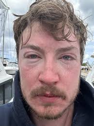 Like a hot iron.' B.C. man's ultra-marathon Hawaiian swim is scuttled by  jellyfish