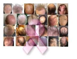 Would you have hair loss when taking axiron? Cancer Hair Loss And Taxotere One Woman S Tragic Story Of Deceit