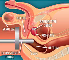 You'll usually only get early symptoms if the cancer grows near the tube you urinate through (the urethra) and presses against it how do you know if you have prostate cancer? Treating Localized Prostate Cancer Effective Health Care Program