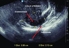 Felicidades para todo el plantel de @laroja, en especial a nuestras #caciquesdeselección ¡qué. Nodulo Hipoecogenico Solido Irregular Infiltrando O Colo Uterino E A Download Scientific Diagram