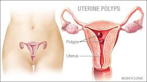 mayo clinic q and a uterine polyps rarely are cancerous