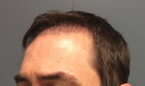 It's minimally invasive and has a quick recovery time. Balding After A Hair Transplant National Hair Loss