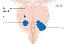 Adenocarcinoma cancers being usually in one of the following organs: Cancer Society Nz Stages And Grades Of Prostate Cancer