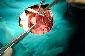 Congenital surgery