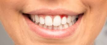 نزيف اللثة أثناء النوم أسباب وعلاج ويب طب