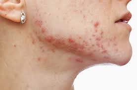 Researchers have observed fungal acne crop up after events that compromise the immune system, such as. How To Get Rid Of Fungal Acne Getridofallthings Com