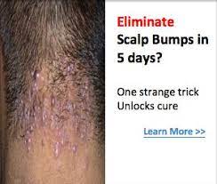 Your Ultimate Remedy For Pimples On Head Pimples On Scalp Scalp Bumps Pimples Remedies