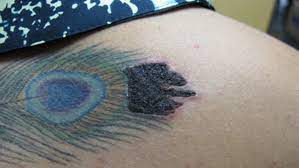 Do not pop blisters, do not scratch, and do not. 6 Possible Laser Tattoo Removal Side Effects And How To Deal With Them Tattoo Removal Institute