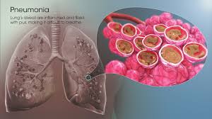 Image result for Pneumonia