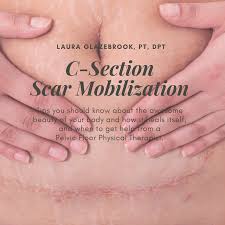To learn more about the sdi and pfl programs, check out the state disability insurance program page at the edd's website. Is My C Section Scar Healing Well One On One Physical Therapy