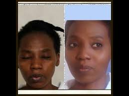 Eclaircir Et Unifier Son Teint Naturellement Fini Taches Et Bouton Youtube Skin Care Skin Youtube